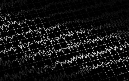 Polysomnography (PSG)